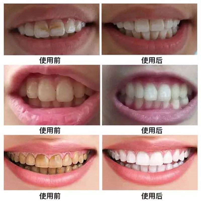 牙齿美白产品